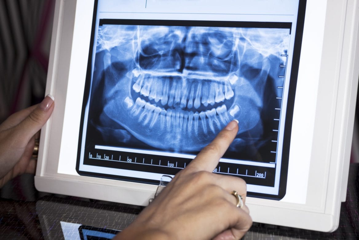 Digital X-rays - Deer Ridge Dental