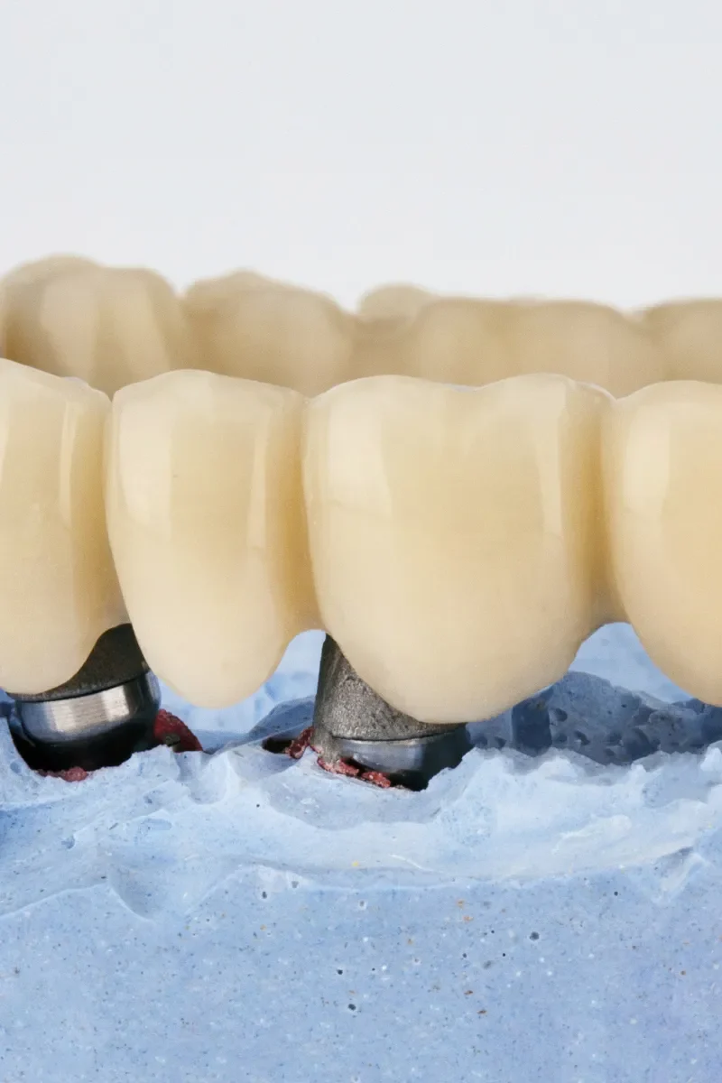 Benefits of Dental Bridges