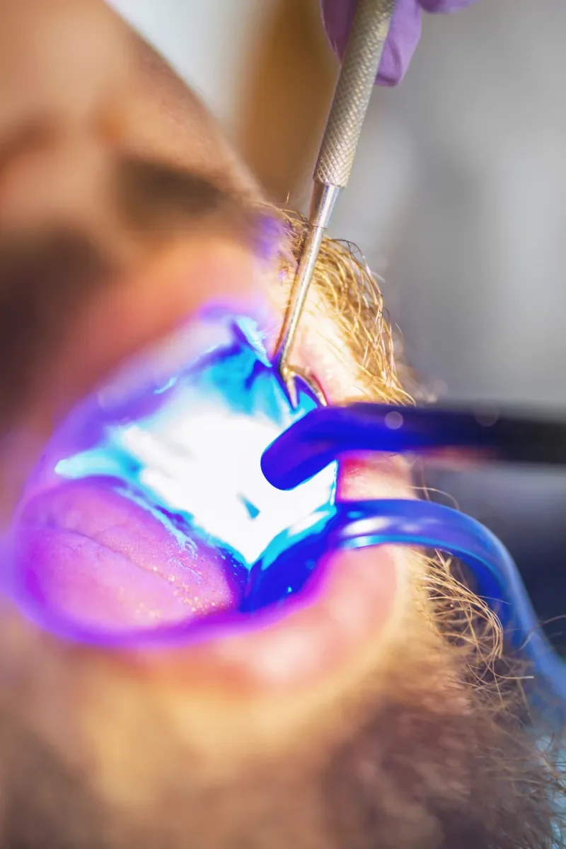 Benefits of Dental Fillings