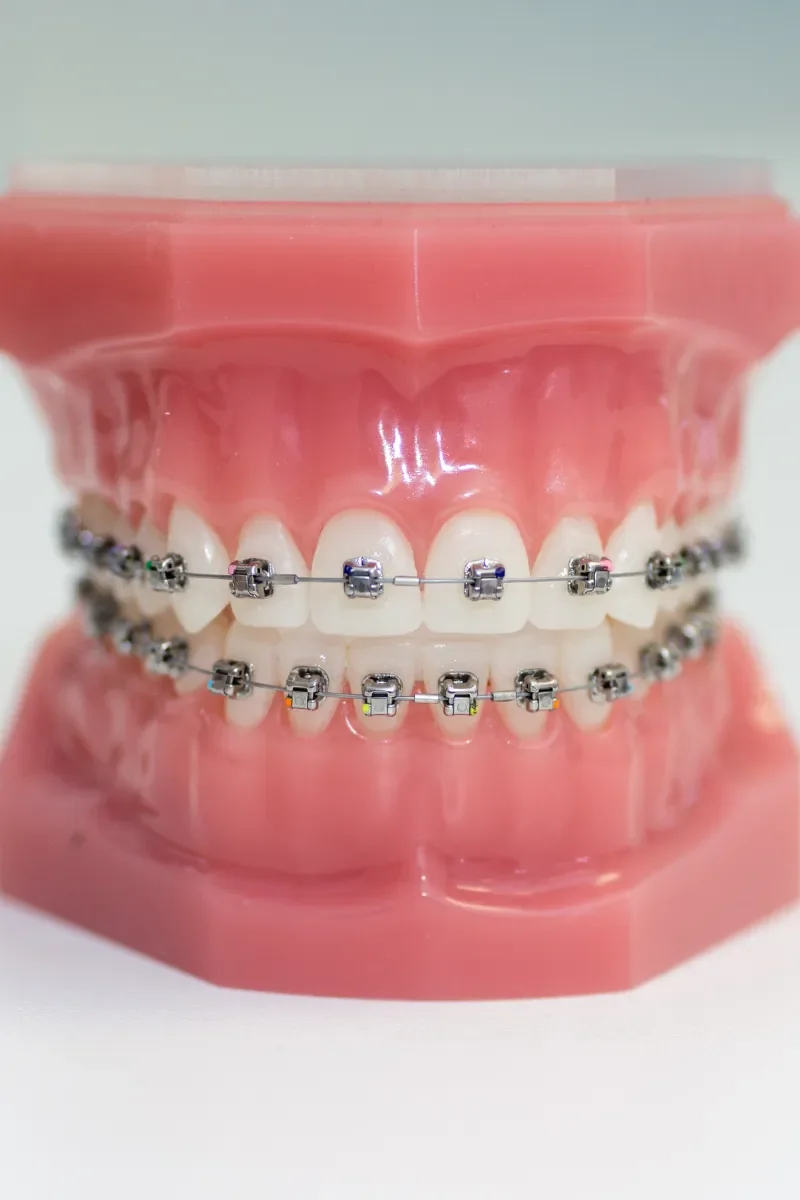 Benefits of Traditional Braces