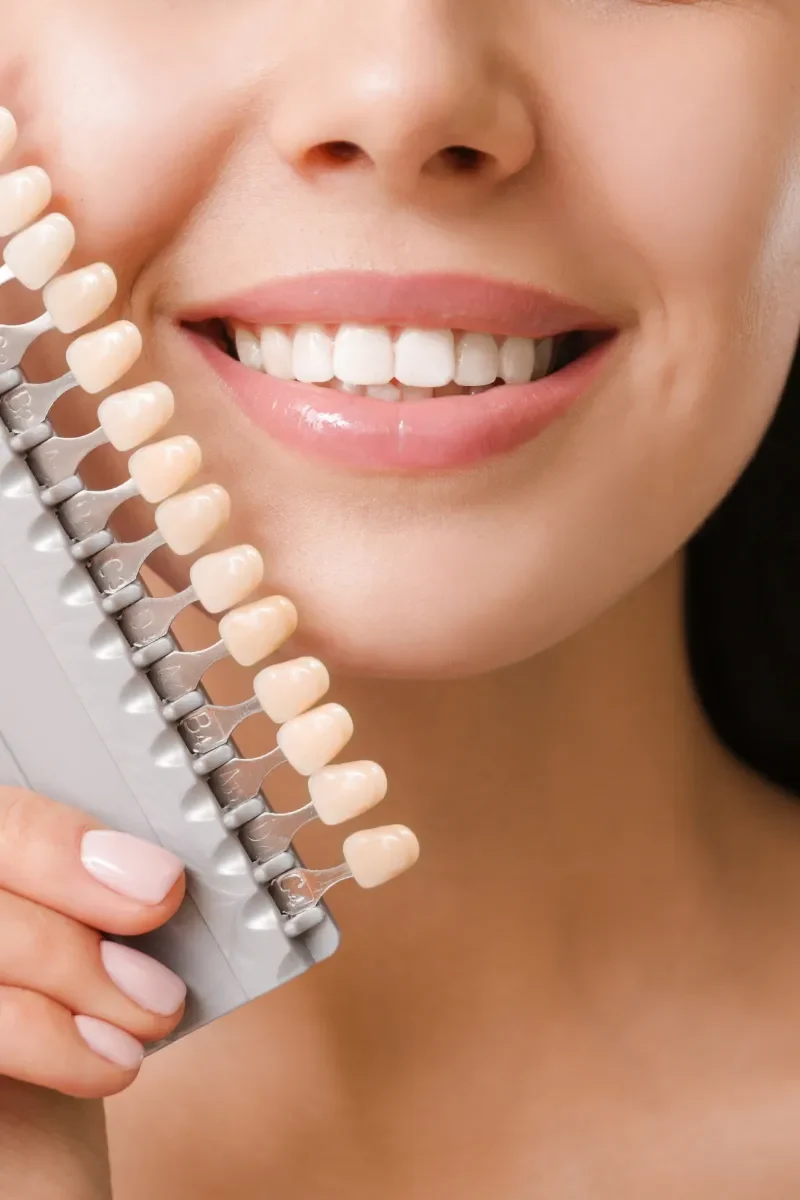 Dental Veneers (1)