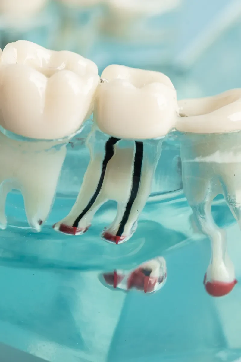 Root Canals (1)